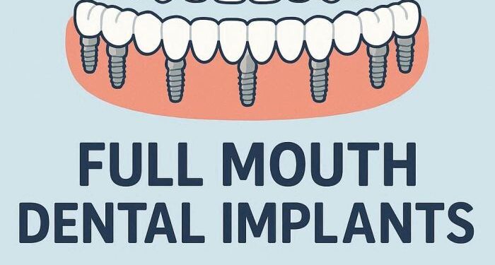 The Definitive Guide to the Estimated Cost of Full Mouth Dental Implants